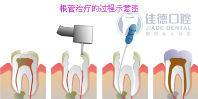 牙痛了怎么快速的止痛呢？