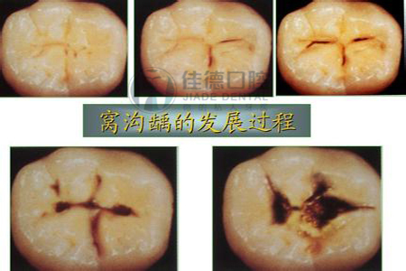 盤點牙痛要怎么快速止痛呢？