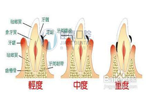 牙齒疾病的修復治療有哪些？