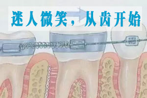 合肥兒童牙齒擁擠矯正費用？