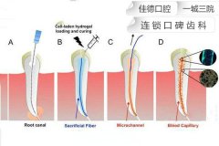 合肥根管的治療多少錢-費用因人而異