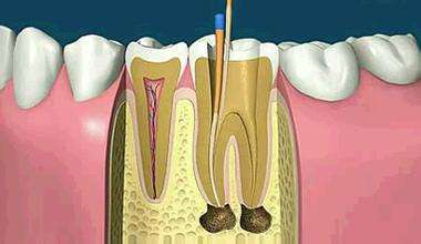 合肥根管的治療多少錢-牙疼別亂忍