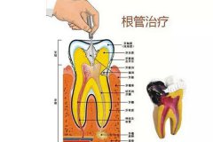 合肥牙齒做根管的治療多少錢?--根管的治療費用是這